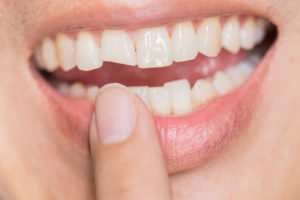 women pointing to her chipped tooth