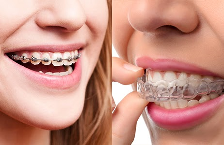 How to Choose Between Braces and Invisalign
